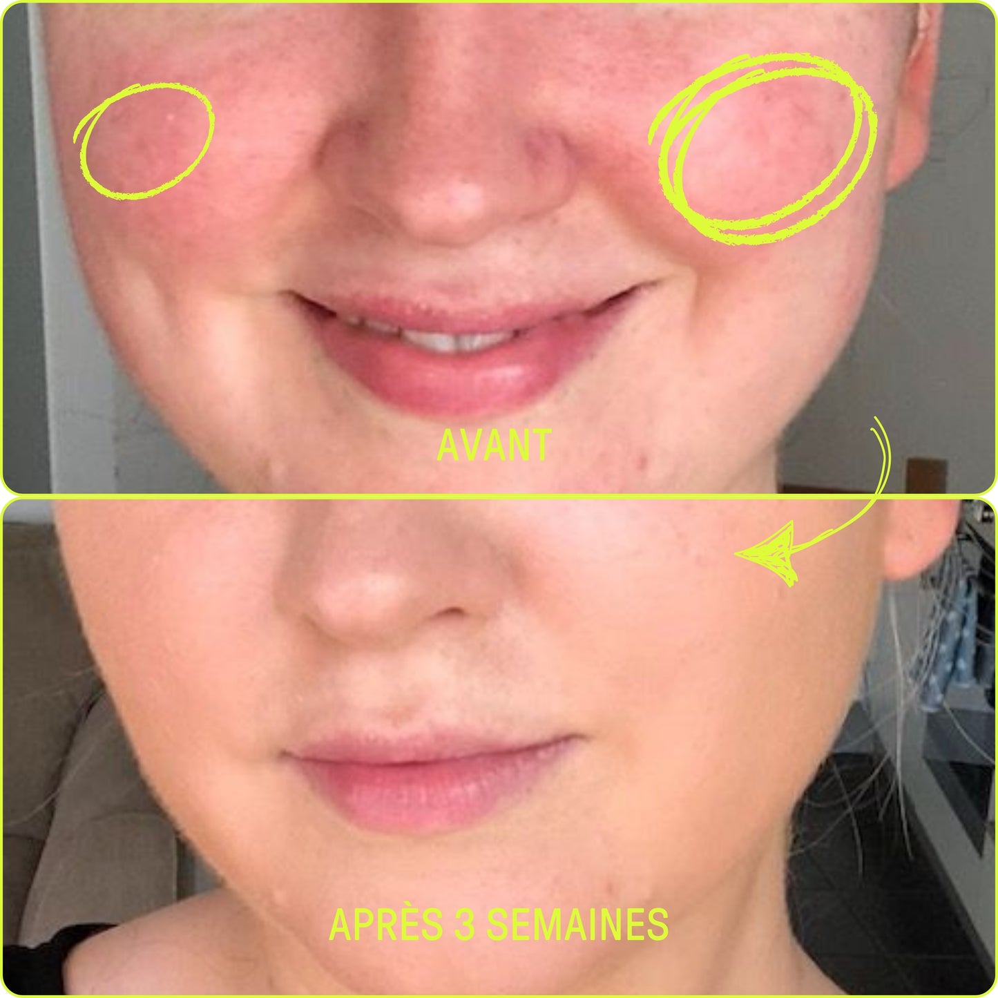 NOTRE DUO ANTI-ROSACÉE