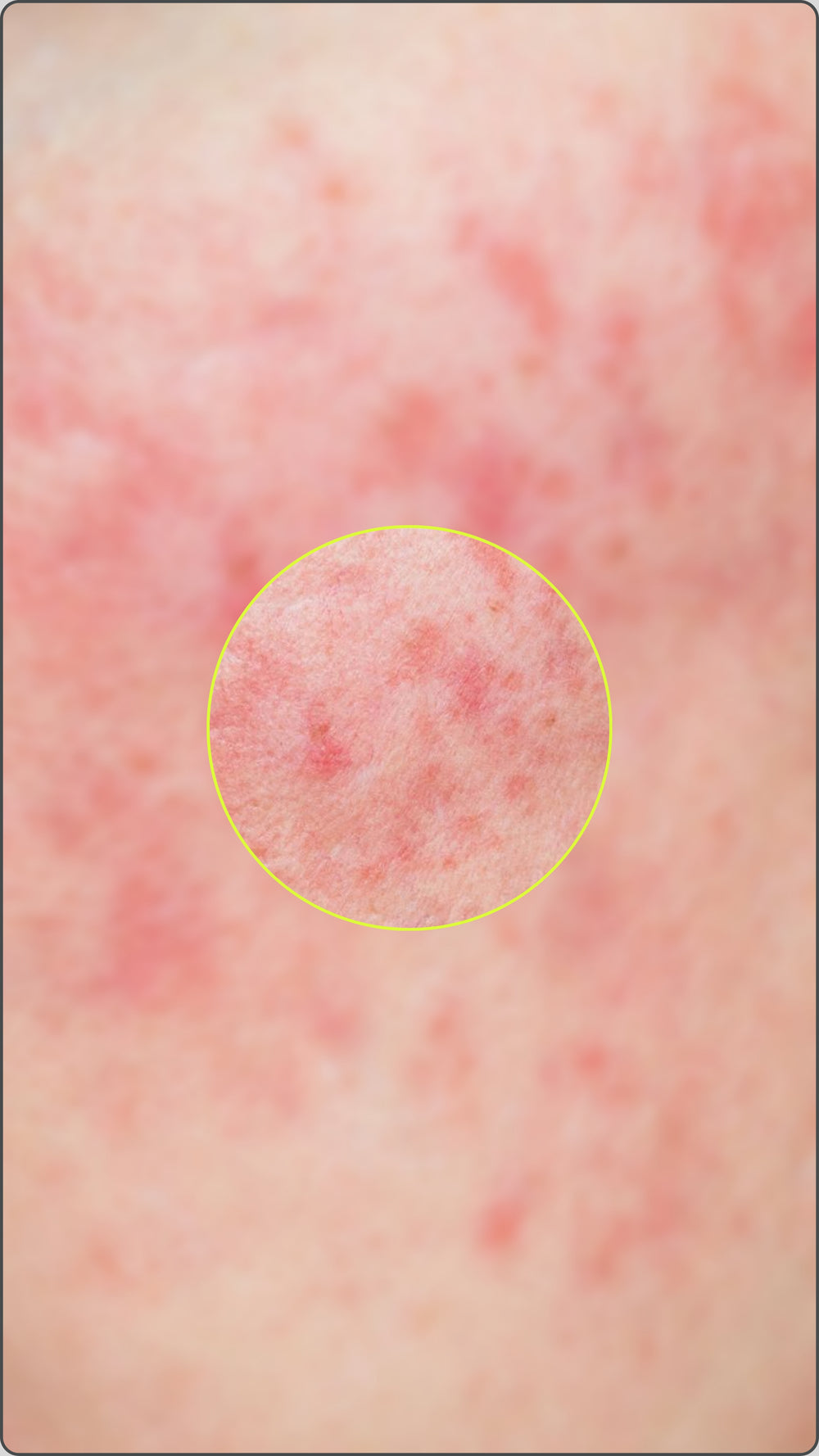 La rosacée papulo-pustuleuse