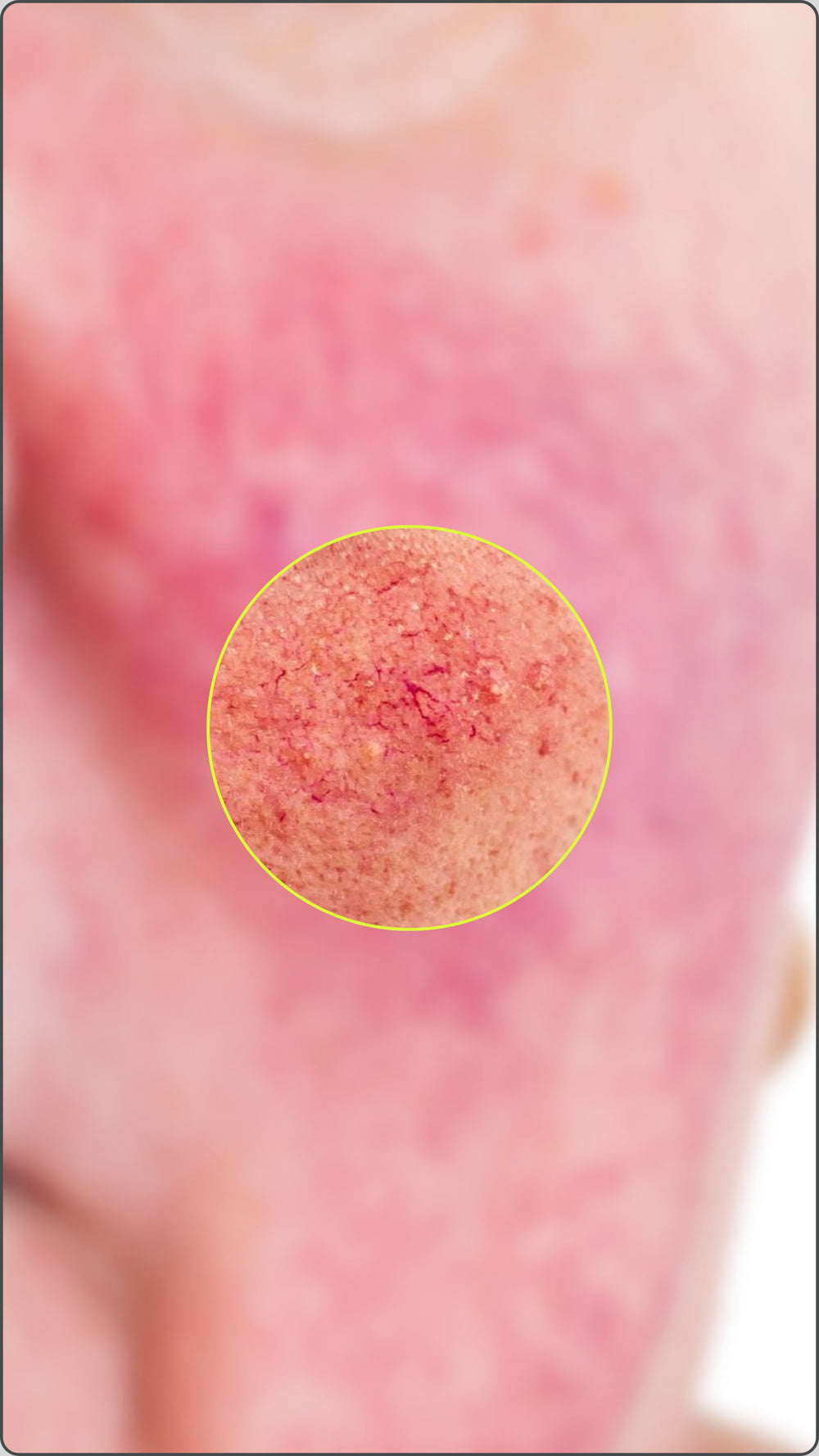 La rosacée vasculaire