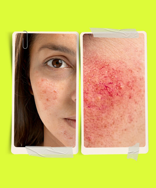 NOTRE DUO ANTI-ROSACÉE