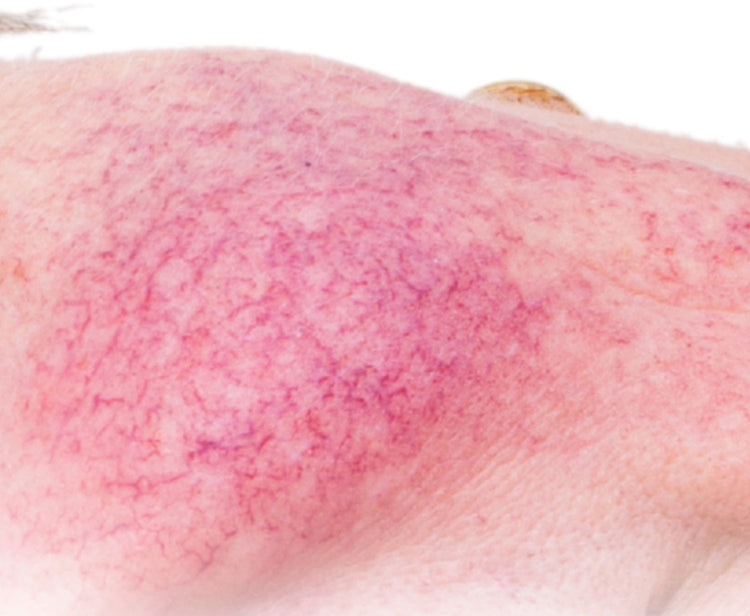 Laboratoire 27 Rosiers : analyse au microscope de peaux sujettes aux rougeurs